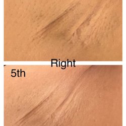 The Beautx Laser & Skin Care - Laser Underarms Whitening Treatment
This is from one of our clients who is very happy with the results