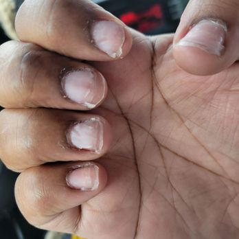 Vogue Nail Spa 2 - Gel caked onto my nails. I left with them undone because of the bad service and this is how she "removed" what she haf done. - Nail Salons Near Me - North Haven, Connecticut Vogue Nail Spa 2 - Gel caked onto my nails. I left with them undone because of the bad service and this is how she "removed" what she haf done. - Nail Salons Near Me - North Haven, Connecticut