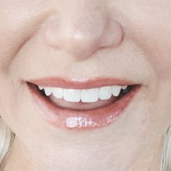 Ackerman Family Dentistry - Happy patient, front teeth fixed!