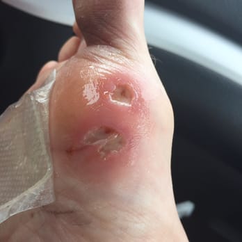 Liberty Nails - Wounds inflicted on my foot from negligent employee of this salon. Developed cellulitis as a result. - Nail Salons Near Me - Kendall Park, New Jersey Liberty Nails - Wounds inflicted on my foot from negligent employee of this salon. Developed cellulitis as a result. - Nail Salons Near Me - Kendall Park, New Jersey
