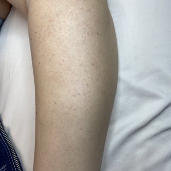 Sugar Smooth - After arm wax - Sugaring Near Me - Huntington Beach, California Sugar Smooth - After arm wax - Sugaring Near Me - Huntington Beach, California