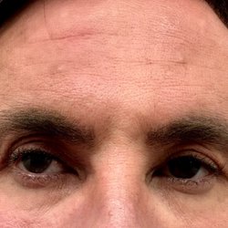 Ophthalmic Surgeons and Physicians - To be totally honest I think it is worse than the first surgery and possibly worse than my original