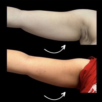 Southern Shapez - Left arm - Massage Near Me - Katy, Texas