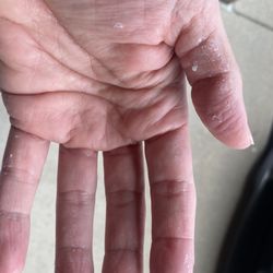 TK Nails Spa & Bar - Skin burned by acetone & polish stuck