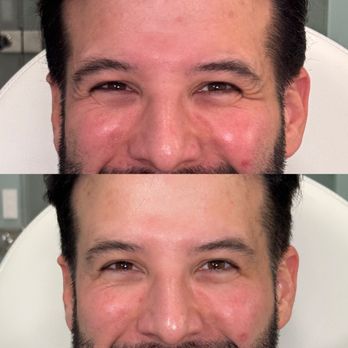The Sknmuse - BROTOX 
Men get botox too! 
Softened crows feet to refresh the face - Medical Spas Near Me - Miami, Florida