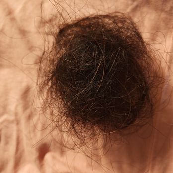 Jungle Fitness - Hair loss due to Telogen effluvium caused by the restrictive diet they put me on - Trainers Near Me - Irvine, California Jungle Fitness - Hair loss due to Telogen effluvium caused by the restrictive diet they put me on - Trainers Near Me - Irvine, California