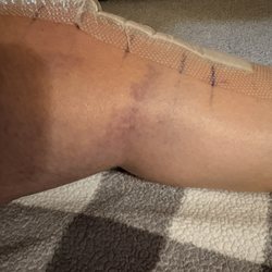 Arrowhead Orthopaedics - Chino Hills - Still healing