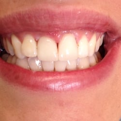Kapadia Dental Care - After placing a Ceramic Crown
