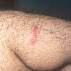 The Inn at Fox Hollow - Bug bites