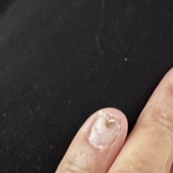 Organic Nails - This was the first day after soaking the nails off. And that is fungus. - Nail Salons Near Me - High Point, North Carolina Organic Nails - This was the first day after soaking the nails off. And that is fungus. - Nail Salons Near Me - High Point, North Carolina