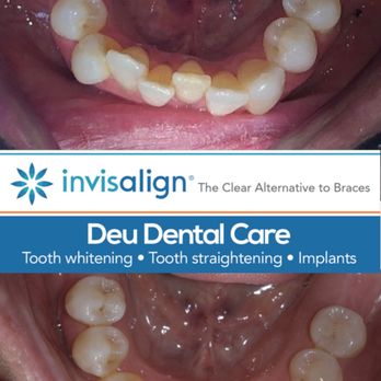 Deu Dental Care - Headingley - tooth alignment- Invisalign - Cosmetic Dentists Near Me - Leeds, XWY Deu Dental Care - Headingley - tooth alignment- Invisalign - Cosmetic Dentists Near Me - Leeds, XWY
