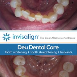 Deu Dental Care - Headingley - Tooth alignment- Invisalign