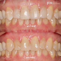 Jin Dental Aesthetics - Composite veneers placed to reenforce weakened and thinning enamel. No drilling or shots involved!