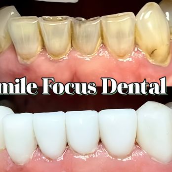 Smile Focus Dental - Lower veneers - General Dentistry Near Me - Stevenson Ranch, California Smile Focus Dental - Lower veneers - General Dentistry Near Me - Stevenson Ranch, California