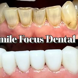 Lower veneers