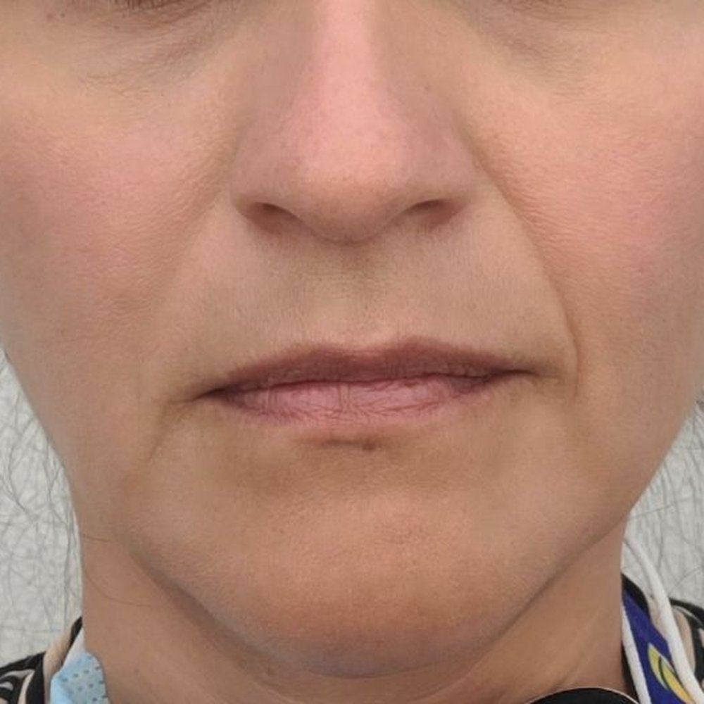 Plush Med Spa - Before fillers - Medical Spas Near Me - Camarillo, California Plush Med Spa - Before fillers - Medical Spas Near Me - Camarillo, California