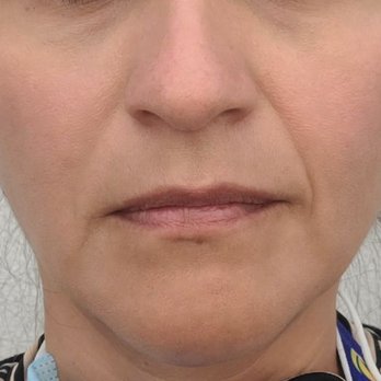 Plush Med Spa - Before fillers - Medical Spas Near Me - Camarillo, California