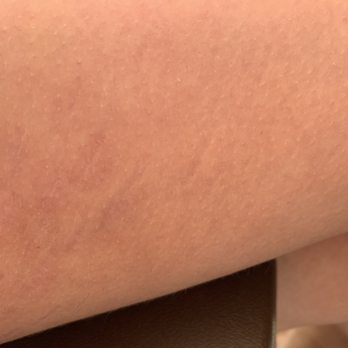 Advanced Laser & Cosmetic Center - After treatment (maybe a couple more sessions) - Hair Removal Near Me - Dayton, Ohio