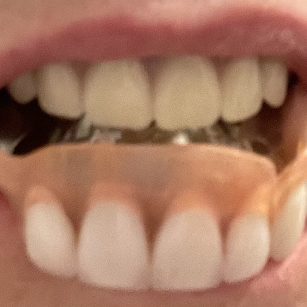 Five Points Family Dentistry - This is the old partial on bottom and the new top in my mouth. - General Dentistry Near Me - Burlington, New Jersey Five Points Family Dentistry - This is the old partial on bottom and the new top in my mouth. - General Dentistry Near Me - Burlington, New Jersey