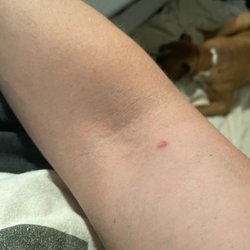 Regency Dermatology - Permanent scar