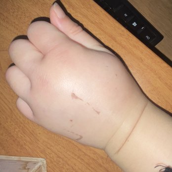 Xpanded Therapies by Alex Waites - My hand a few days after surgery due to IV. - Massage Therapy Near Me - Ventura, California Xpanded Therapies by Alex Waites - My hand a few days after surgery due to IV. - Massage Therapy Near Me - Ventura, California
