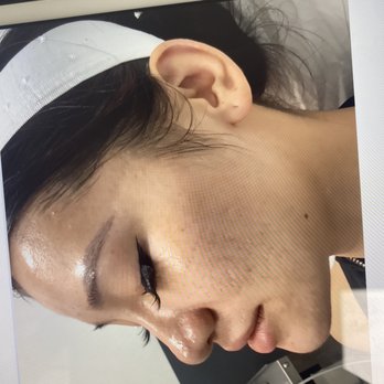 LaserAway - The 6th session of clear and brilliant. - Medical Spas Near Me - Las Vegas, Nevada LaserAway - The 6th session of clear and brilliant. - Medical Spas Near Me - Las Vegas, Nevada