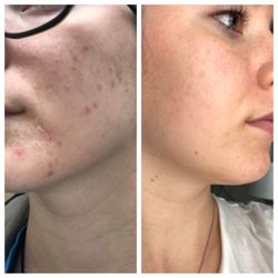 Truth Beauty Spa - Before and after of acne treatment.