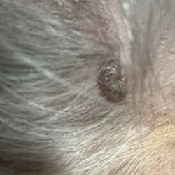 Rattet Jeffrey P MD - A mole in my scalp.