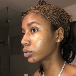 Chemical burns