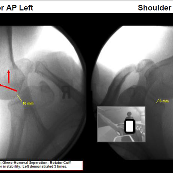 Digital Motion Xray - Auto "Accidents," Whiplash Injuries cause catastrophic failure of Shoulder Ligaments. Digital Motion X-ray can demonstrate the severity. - Diagnostic Imaging Near Me - Ogden, Utah