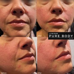 Lumiere Pure Body Med Spa - Facial Filler