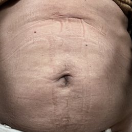 2 years after smart lipo skin rippling, and lumpy, skin sagging - so embarrassing 2 years after smart lipo skin rippling, and lumpy, skin sagging - so embarrassing