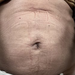 The Falcone Center - 2 years after smart lipo skin rippling, and lumpy, skin sagging - so embarrassing