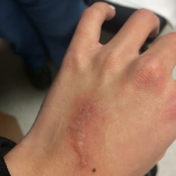 Pro Q Nails - The burn on my hand from their shellac dryer - Nail Salons Near Me - San Antonio, Texas