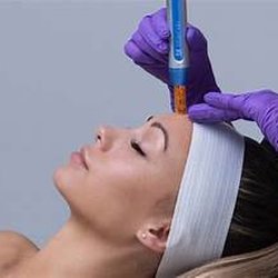 The Apothecary Wellness Center and Spa - Nano Pen Microexfoliation Facials