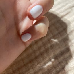 Bubble in my pinky