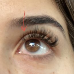Bald spots day after getting them done where lashes fell out. Bald spots day after getting them done where lashes fell out.