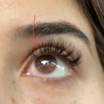 The Lash Lounge - Bald spots day after getting them done where lashes fell out. - Eyelash Service Near Me - Pinecrest, Florida The Lash Lounge - Bald spots day after getting them done where lashes fell out. - Eyelash Service Near Me - Pinecrest, Florida