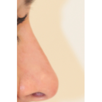 PERK Plastic Surgery - After - Cosmetic Surgeons Near Me - Beverly Hills, California PERK Plastic Surgery - After - Cosmetic Surgeons Near Me - Beverly Hills, California
