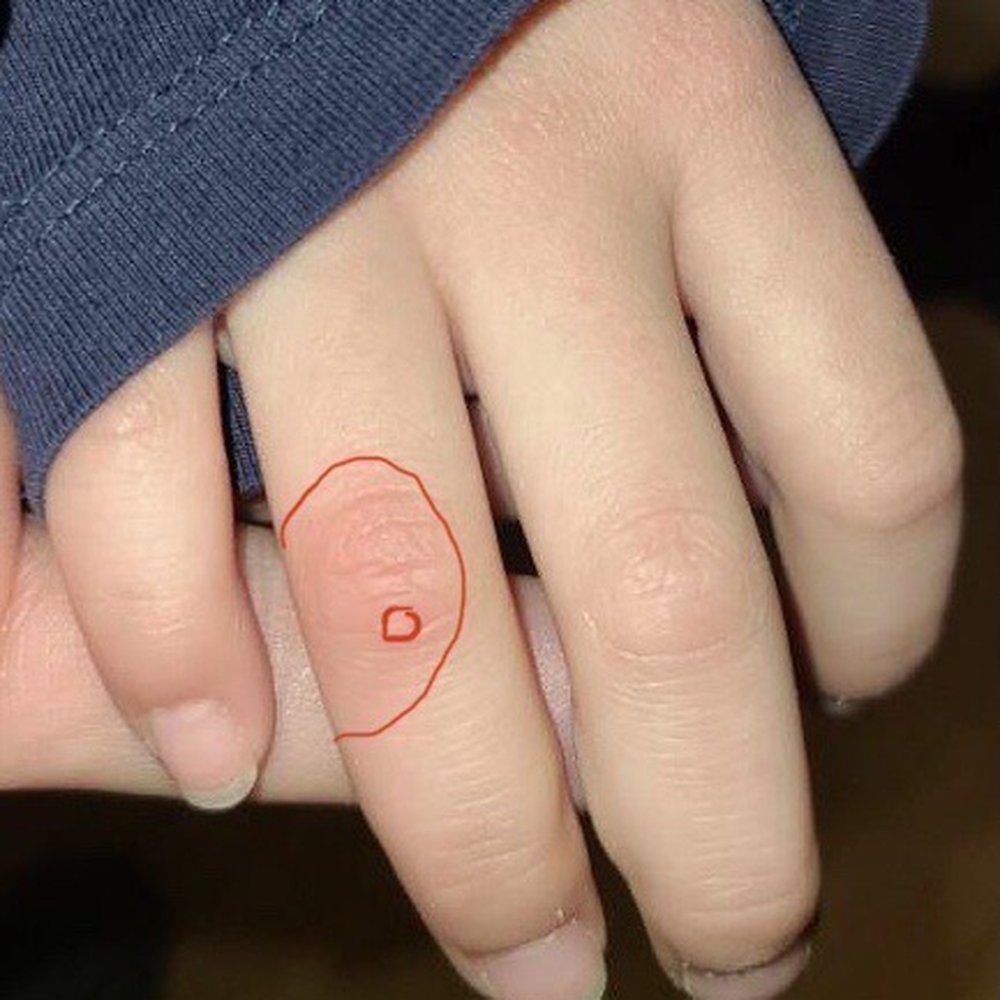 Tiny wart and big red burned area
