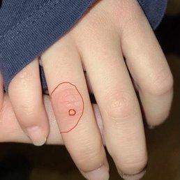 Tiny wart and big red burned area