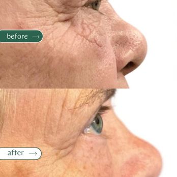 Thrive Medical Spa - Evo Laser Before/After - Medical Spas Near Me - Milton, Georgia