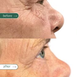 Evo Laser Before/After