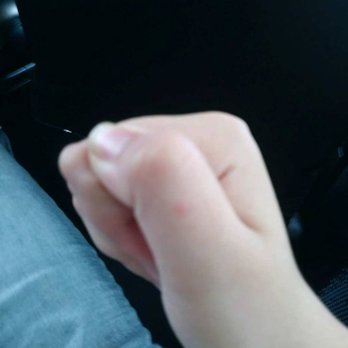 Baymont by Wyndham Chicago/Alsip - Some of my 11 year old sister's bed bug bites from the Baymont Inn And Suites Alsip, IL. - Hotels Near Me - Alsip, Illinois Baymont by Wyndham Chicago/Alsip - Some of my 11 year old sister's bed bug bites from the Baymont Inn And Suites Alsip, IL. - Hotels Near Me - Alsip, Illinois