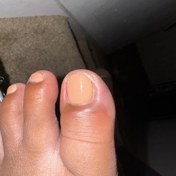 Classy Nail - Swollen toe - Nail Salons Near Me - Federal Way, Washington Classy Nail - Swollen toe - Nail Salons Near Me - Federal Way, Washington