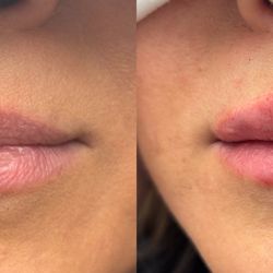 Zuliani Facial Aesthetics - Before & Immediately After Lip Filler.