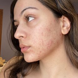 Sandra Velandia - This is my skin maybe 80% healed. It was so much worse.
