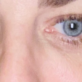 Face by Erin - You can see the bulges under the eyes. You're not supposed to see these types of clumps. - Medical Spas Near Me - Portland, Oregon