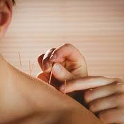 McGraw Chiropractic Acupuncture - Acupuncture is often used for anxiety and depression, fibromyalgia, osteoarthritis.