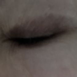 Michael Neimkin - Ophthalmic Plastic and Cosmetic Surgery - Deep purple lid and undereye, white scar across top of purple on both eyes